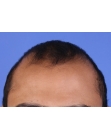 Before Hair Transplant  2 Sessions (Areas)